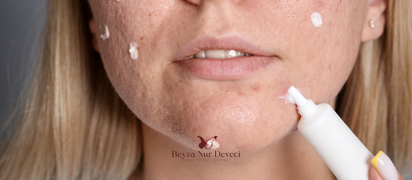 Akne Tedavisi