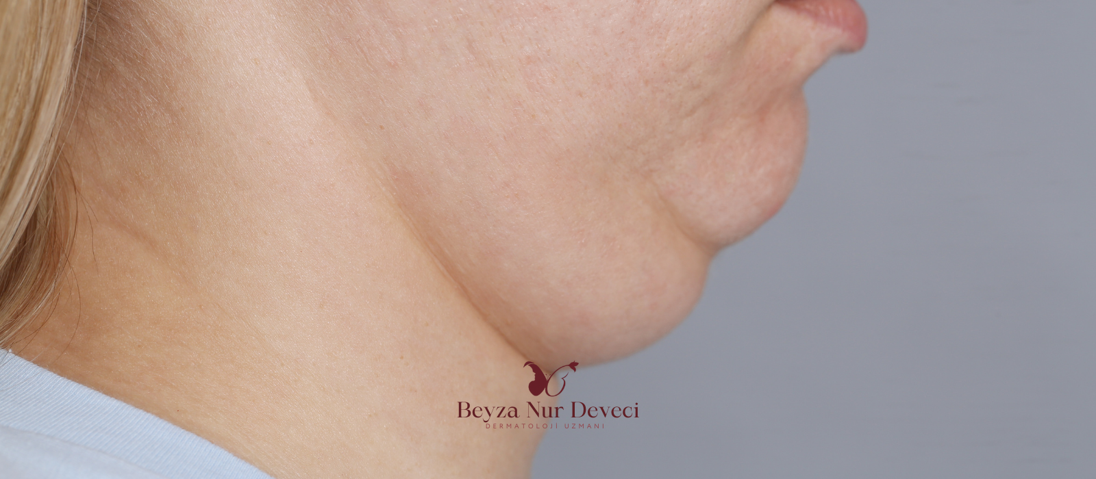 Gıdı ve Yağ Yakma Mezoterapisi