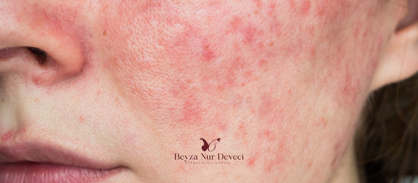 Gül Hastalığı (Rosacea)