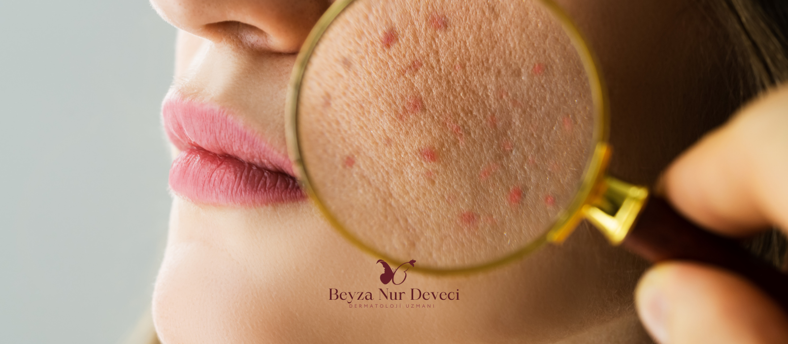 Akne İzi Tedavisi