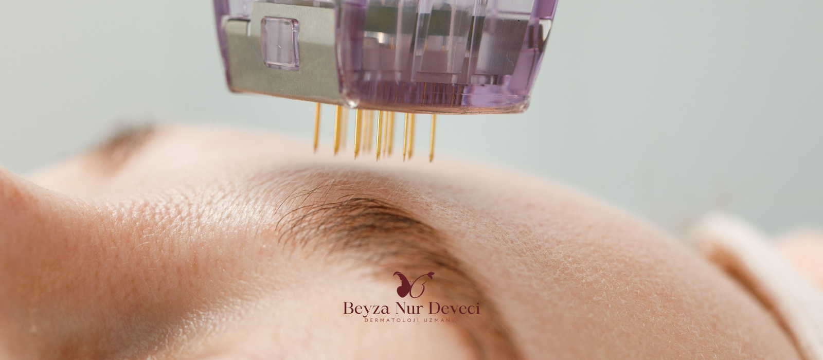 Altın İğne (İğneli Radyofrekans)